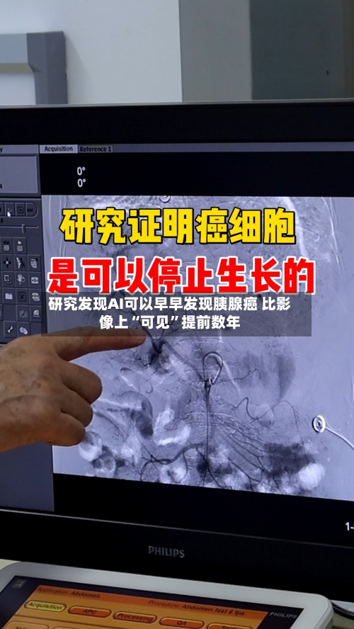 研究发现AI可以早早发现胰腺癌 比影像上“可见”提前数年-第2张图片