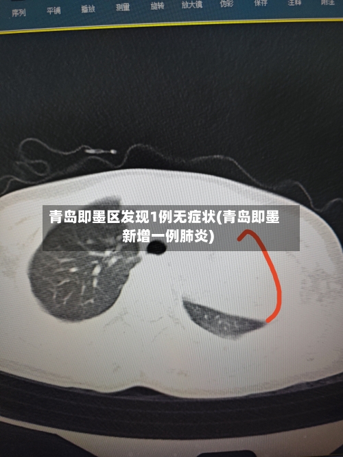 青岛即墨区发现1例无症状(青岛即墨新增一例肺炎)